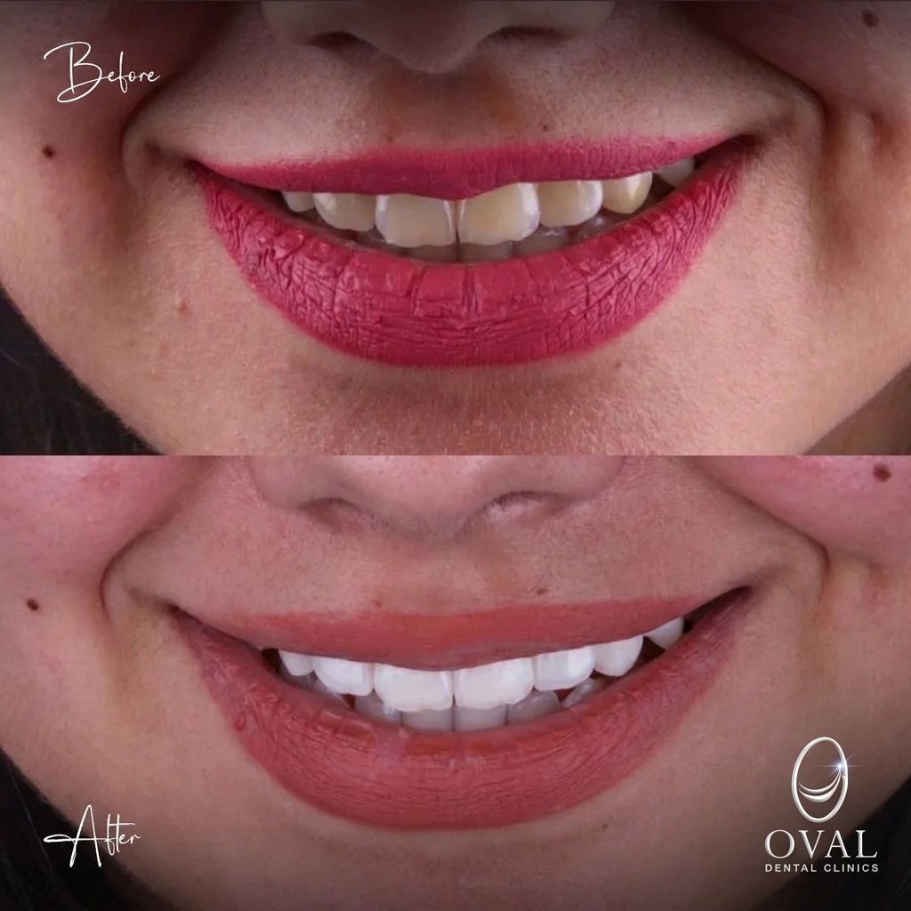 نتيجة قبل وبعد — Oval Dental Clinics