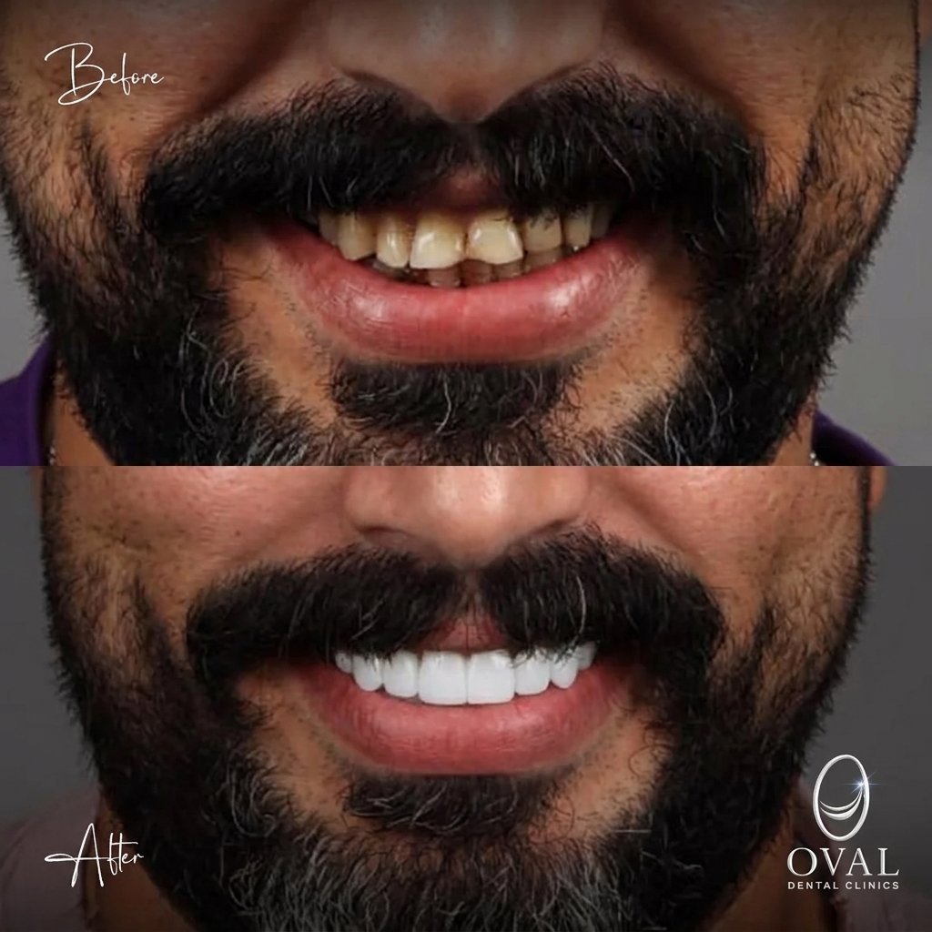 نتيجة قبل وبعد — Oval Dental Clinics