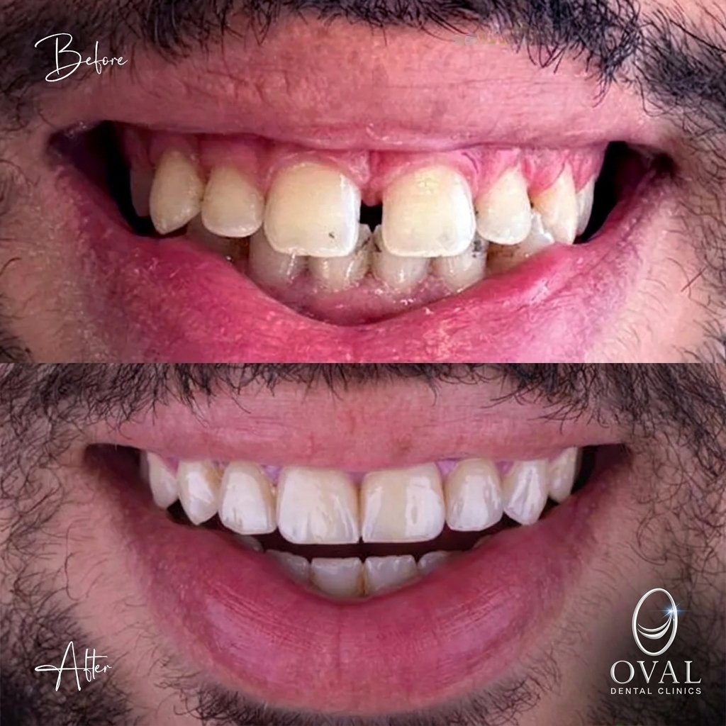 نتيجة قبل وبعد — Oval Dental Clinics