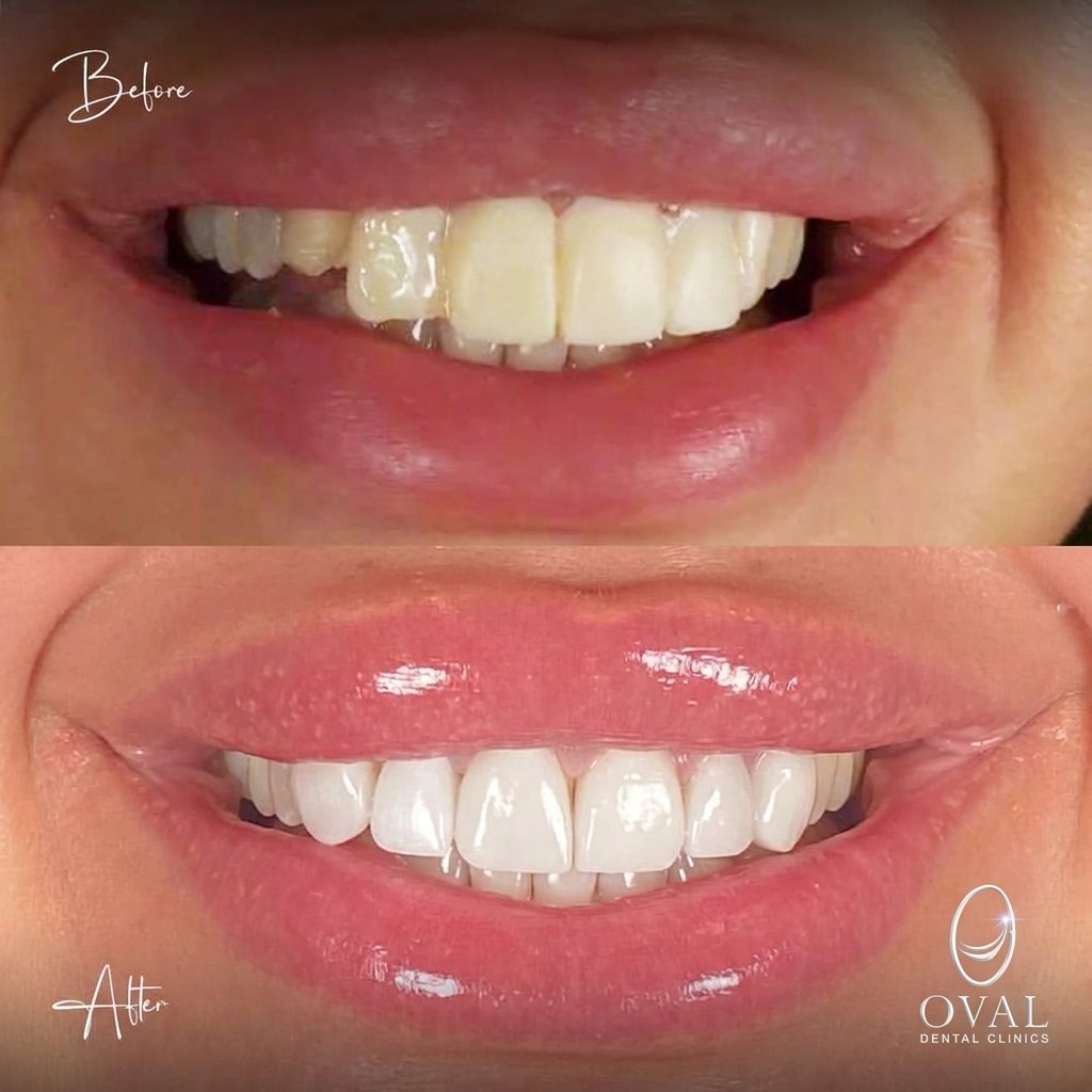 نتيجة قبل وبعد — Oval Dental Clinics